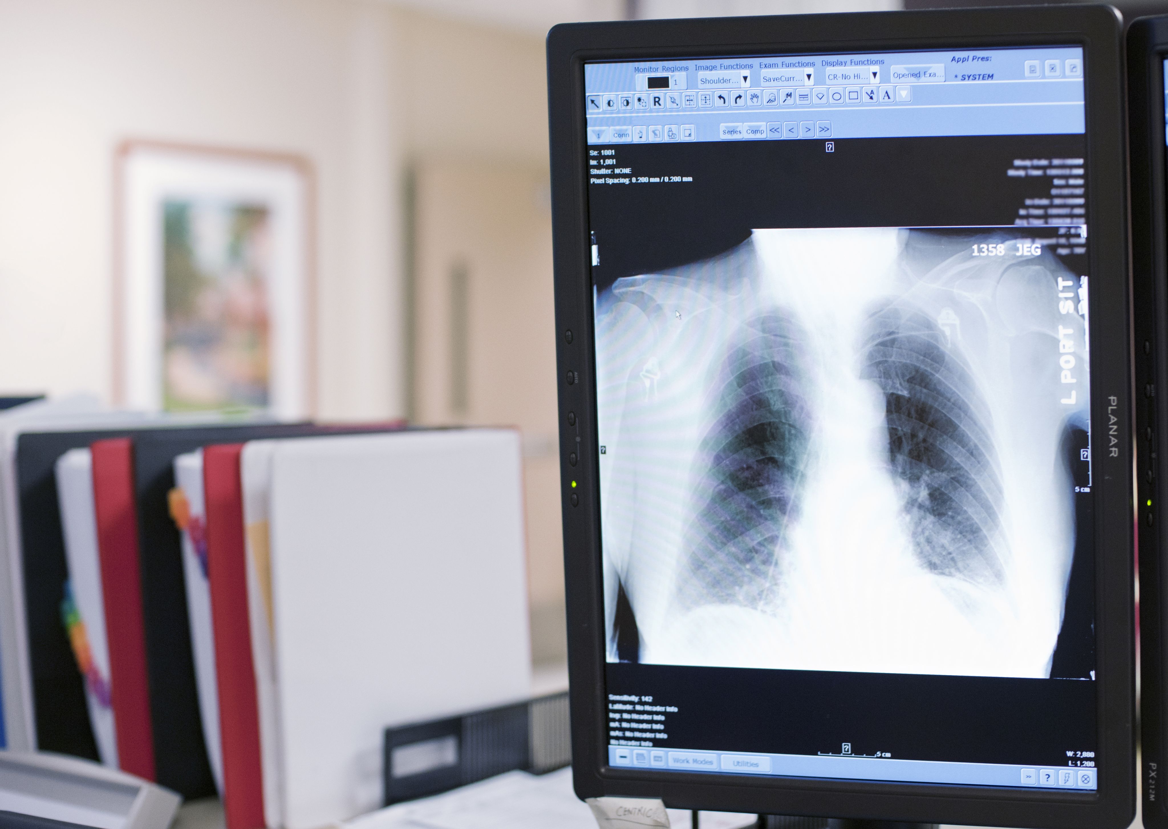 Image of chest X-Ray on home computer screen